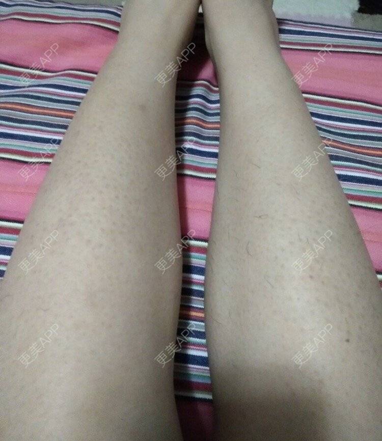 更美 - ~雅的大腿脱毛经验 | 大腿脱毛 | 南昌