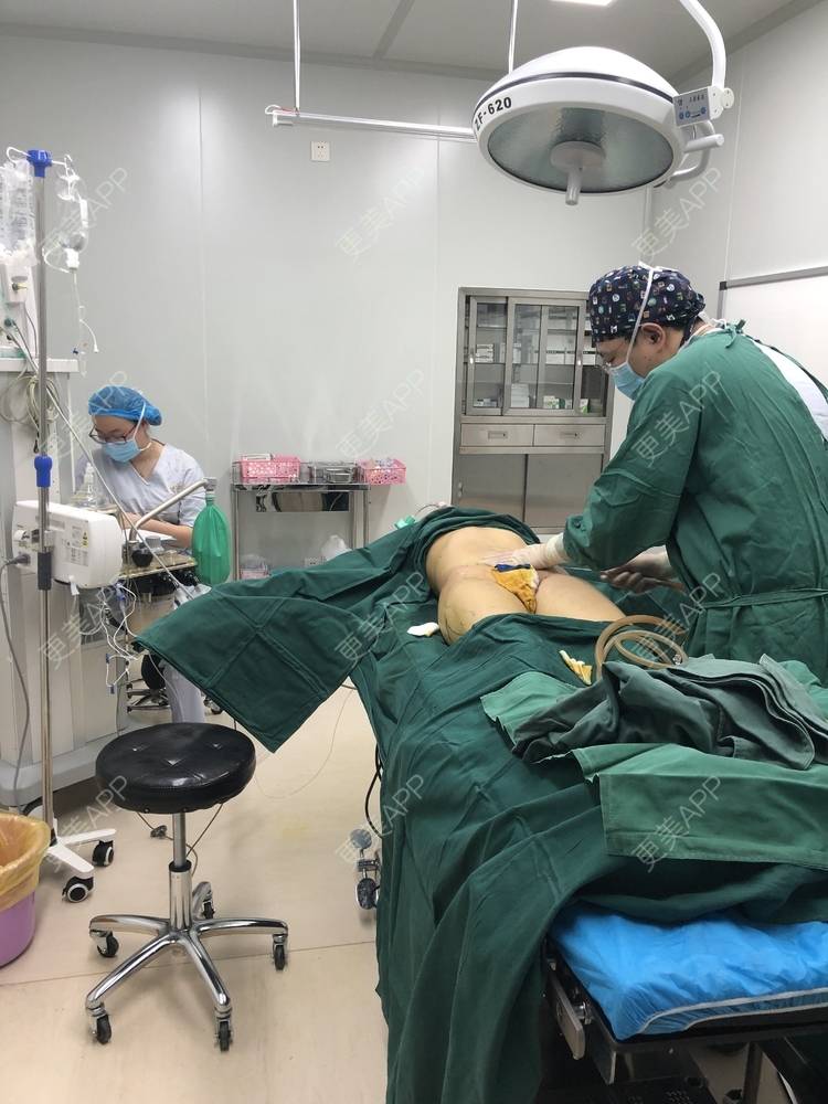 热泪都为你操的腰腹吸脂日记