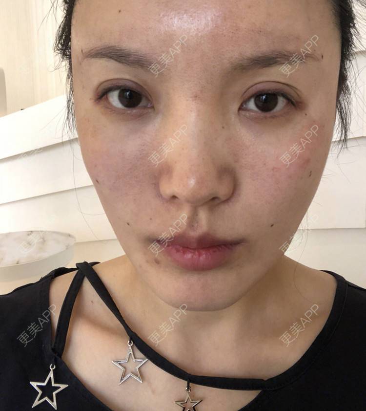 更美 - 更美用户Cq0Cts6778的胶原蛋白丰太阳穴经验 | 胶原蛋白丰太阳穴 | 杭州