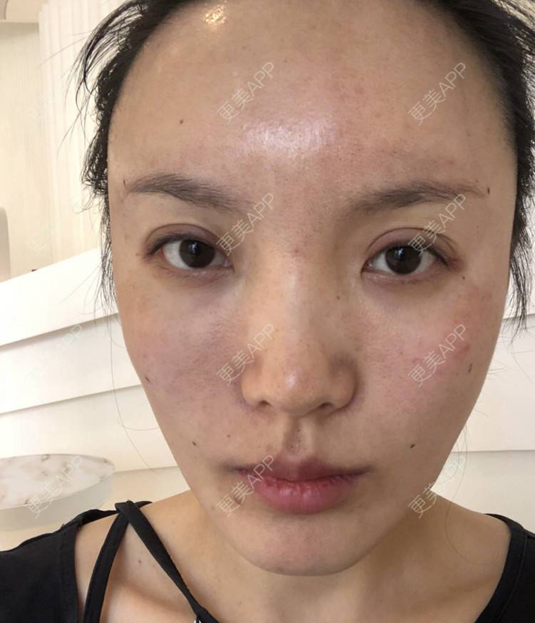 更美 - 更美用户Cq0Cts6778的胶原蛋白丰太阳穴经验 | 胶原蛋白丰太阳穴 | 杭州