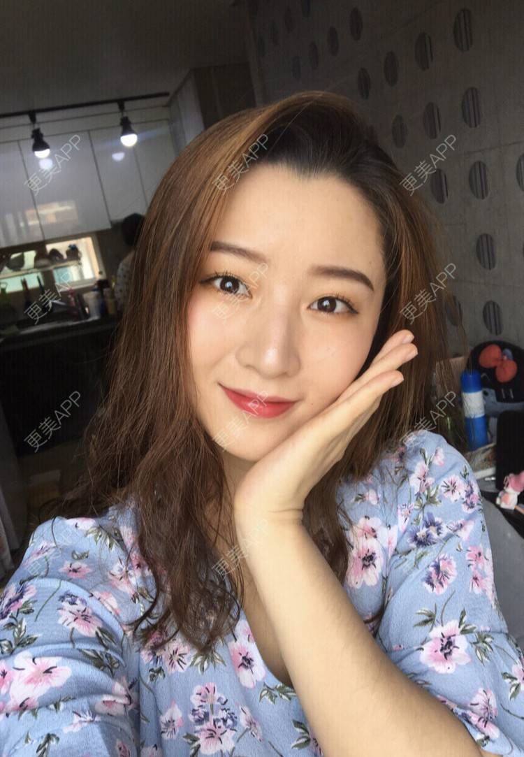 更美 - 更美用户qkGPAi9nyv的胶原蛋白丰面颊经验 | 胶原蛋白丰面颊 | 杭州
