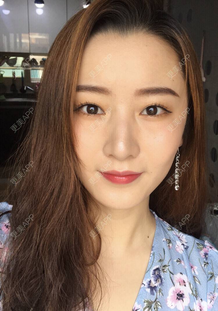 更美 - 更美用户qkGPAi9nyv的胶原蛋白丰面颊经验 | 胶原蛋白丰面颊 | 杭州