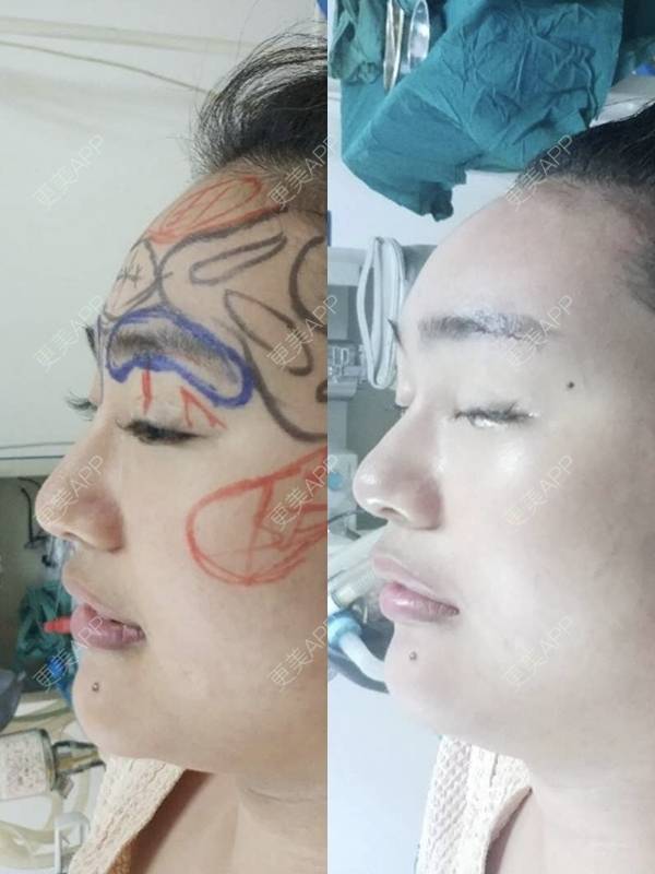 更美 - 红薯冰的硅胶垫眉弓经验 | 北京 | 硅胶垫眉弓