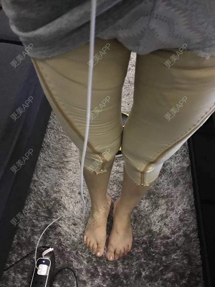 更美 - 如花似玉蔚次的超声溶脂经验 | 超声溶脂