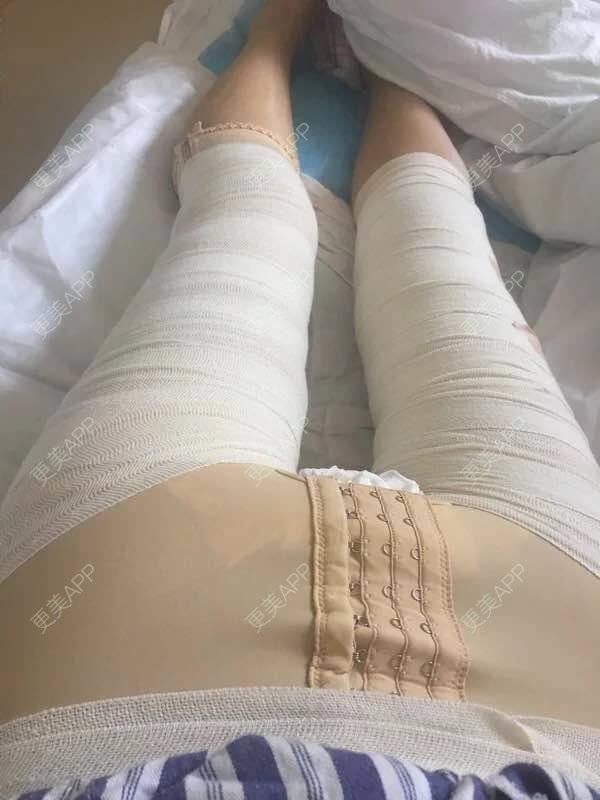 更美 - 如花似玉蔚次的超声溶脂经验 | 超声溶脂