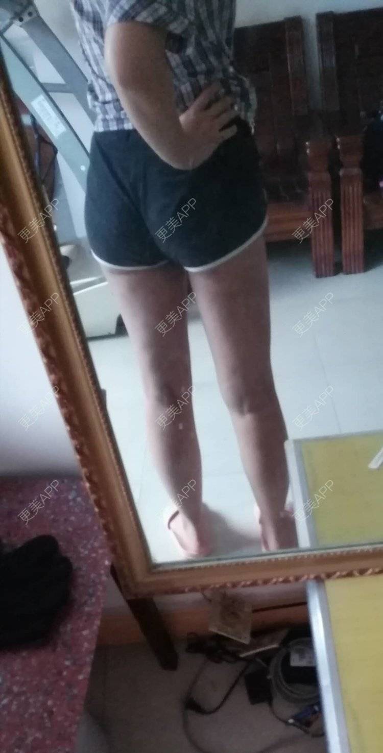 更美用户z8dyxw9mlu的吸脂瘦大腿日记