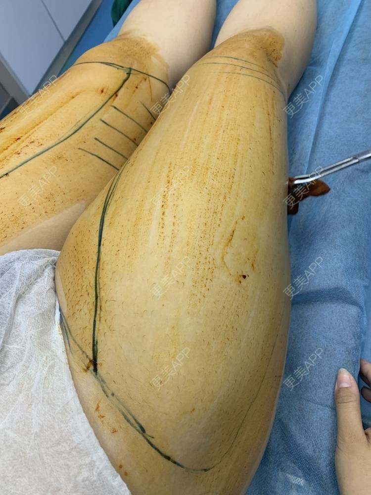 吸脂瘦大腿手术_更美用户igegmyjepg吸脂瘦大腿手术_更美整形