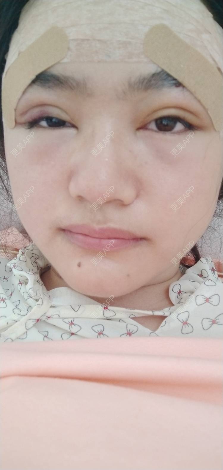 更美 - 红薯冰的硅胶垫眉弓经验 | 北京 | 硅胶垫眉弓
