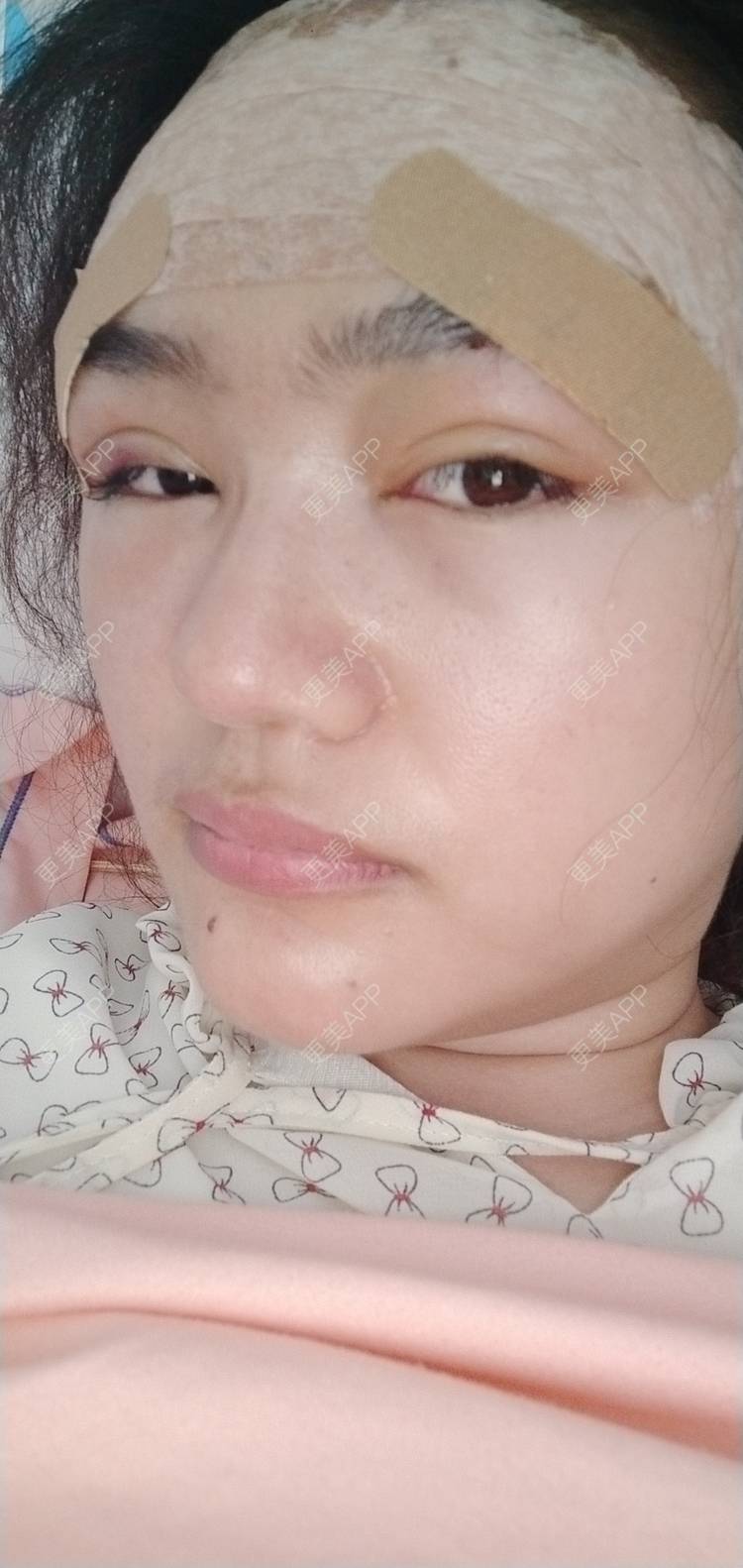 更美 - 红薯冰的硅胶垫眉弓经验 | 北京 | 硅胶垫眉弓