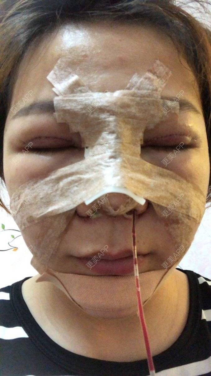 更美 - 更美用户RnU8VdcnCU的鼻部多项经验 | 膨体隆鼻 | 鼻翼缩小 | 鼻部多项 | 自体软骨垫鼻尖 | 鼻小柱延长 | 佛山