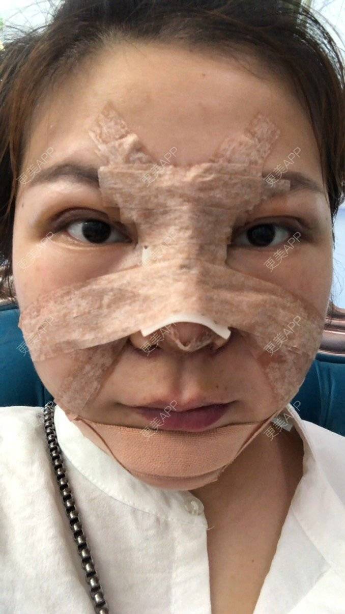 更美 - 更美用户RnU8VdcnCU的鼻部多项经验 | 鼻部多项 | 自体软骨垫鼻尖 | 膨体隆鼻 | 鼻翼缩小 | 佛山 | 鼻小柱延长