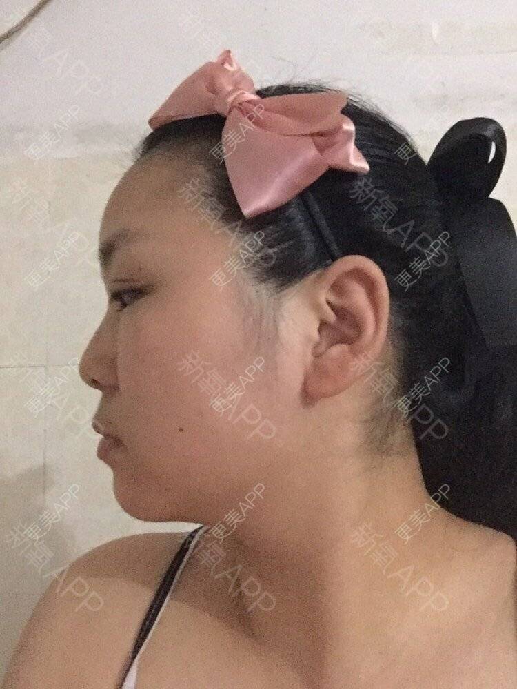更美 - 爱美的洋洋的自体软骨垫鼻尖经验 | 耳软骨隆鼻 | 自体软骨垫鼻尖 | 佛山