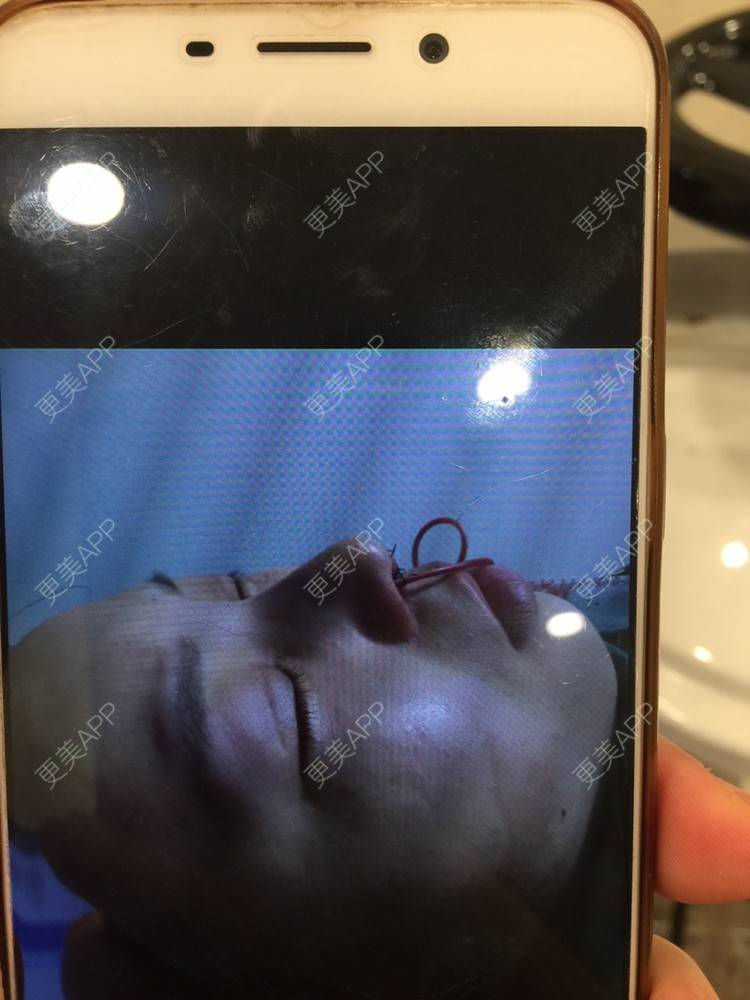 更美 - 爱美的洋洋的自体软骨垫鼻尖经验 | 耳软骨隆鼻 | 自体软骨垫鼻尖 | 佛山