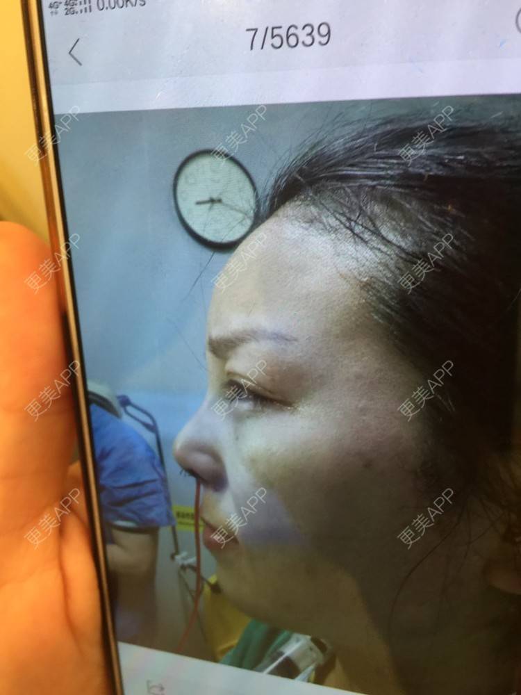 更美 - 爱美的洋洋的自体软骨垫鼻尖经验 | 耳软骨隆鼻 | 自体软骨垫鼻尖 | 佛山
