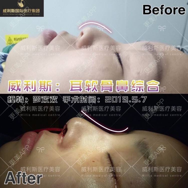 更美 - 爱美的洋洋的自体软骨垫鼻尖经验 | 耳软骨隆鼻 | 自体软骨垫鼻尖 | 佛山