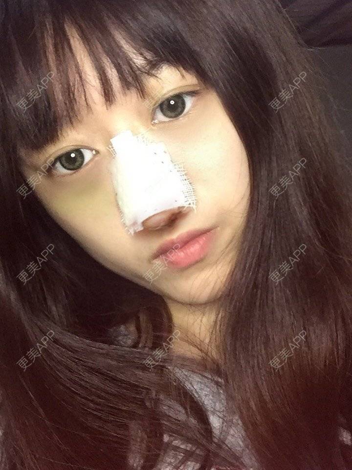 更美 - 妞妞牛小米的鼻部多项经验 | 鼻部多项 | 手术缩鼻头 | 自体软骨垫鼻尖 | 鼻中隔软骨垫鼻头 | 上海