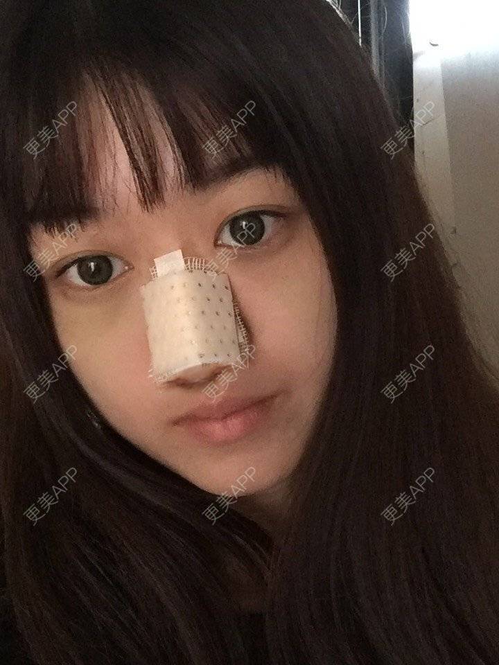 更美 - 妞妞牛小米的鼻部多项经验 | 鼻部多项 | 手术缩鼻头 | 自体软骨垫鼻尖 | 鼻中隔软骨垫鼻头 | 上海