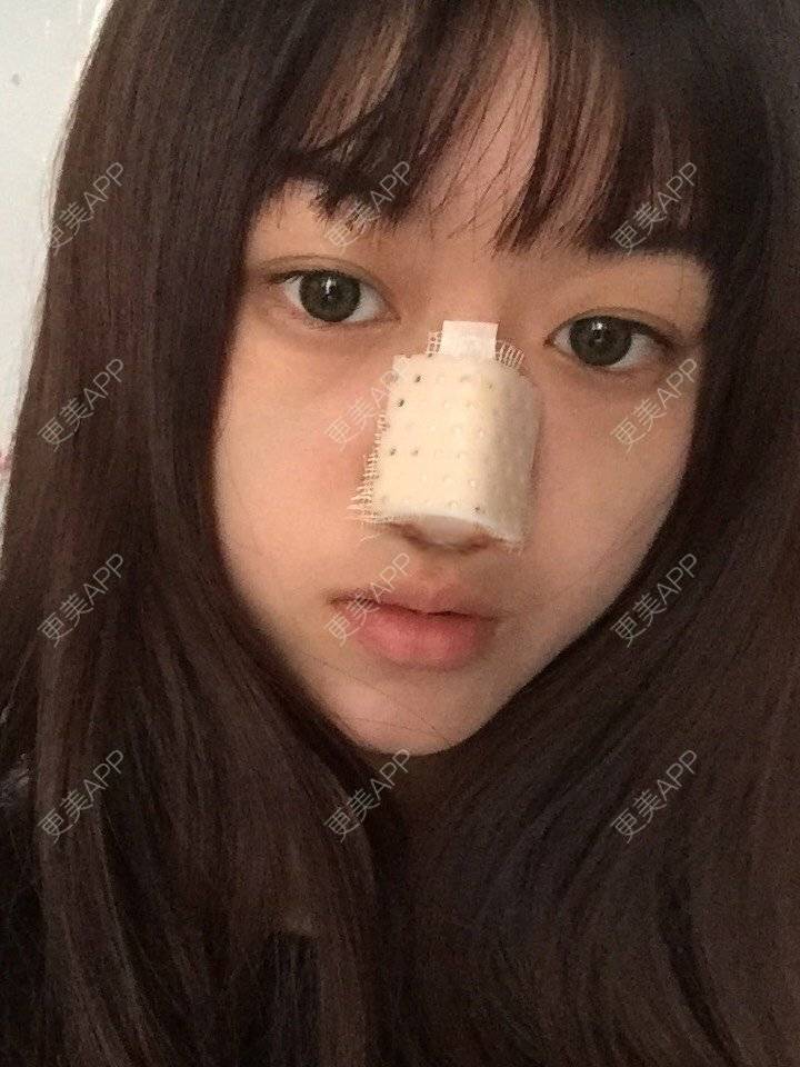 更美 - 妞妞牛小米的鼻部多项经验 | 鼻部多项 | 手术缩鼻头 | 自体软骨垫鼻尖 | 鼻中隔软骨垫鼻头 | 上海