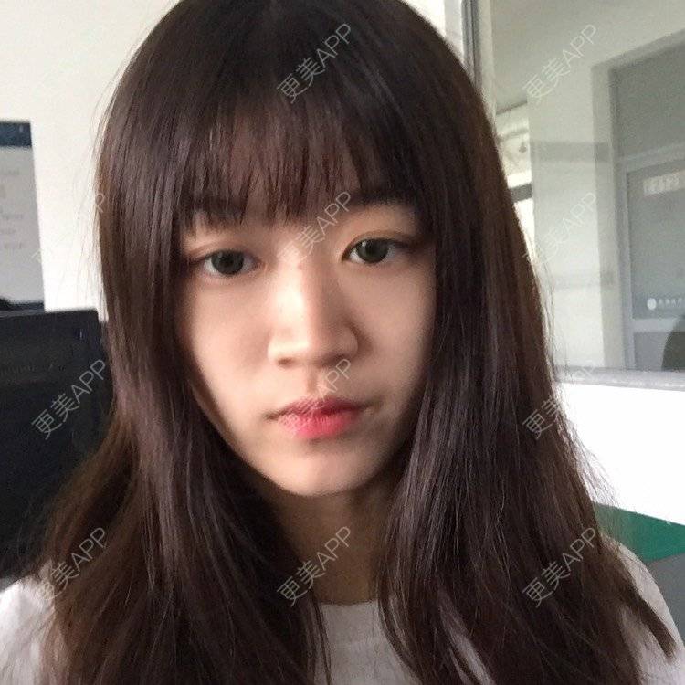 更美 - 妞妞牛小米的鼻部多项经验 | 鼻部多项 | 手术缩鼻头 | 自体软骨垫鼻尖 | 鼻中隔软骨垫鼻头 | 上海