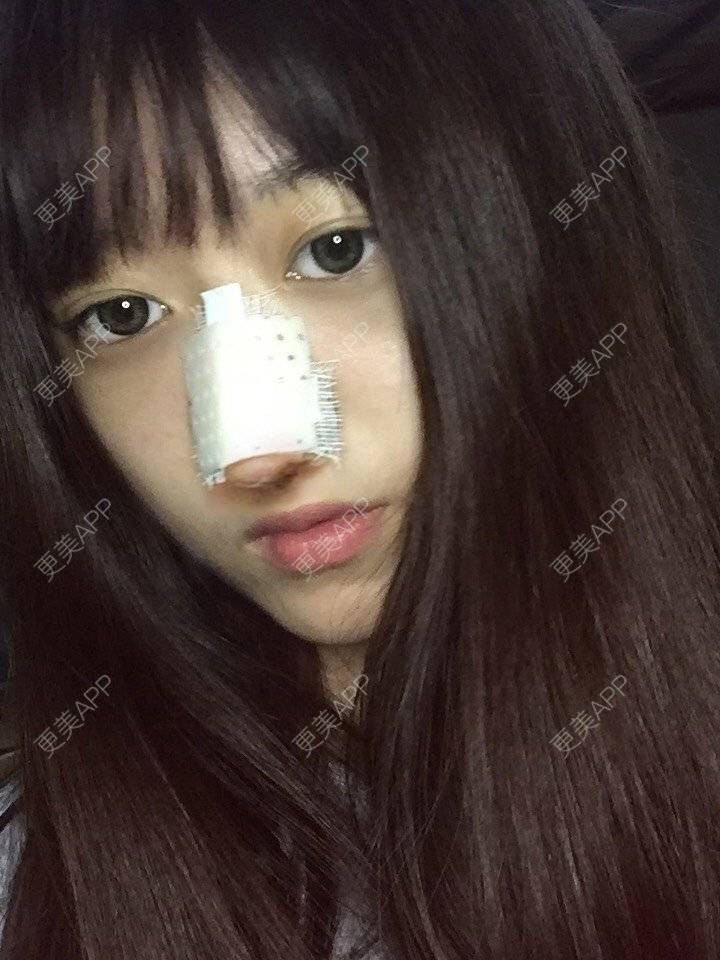 更美 - 妞妞牛小米的鼻部多项经验 | 鼻部多项 | 手术缩鼻头 | 自体软骨垫鼻尖 | 鼻中隔软骨垫鼻头 | 上海