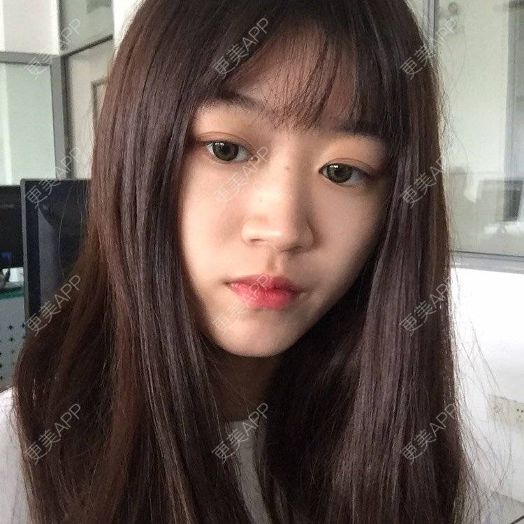 更美 - 妞妞牛小米的鼻部多项经验 | 鼻部多项 | 手术缩鼻头 | 自体软骨垫鼻尖 | 鼻中隔软骨垫鼻头 | 上海
