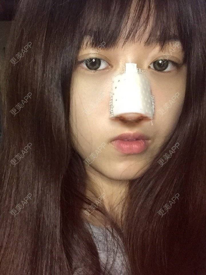 更美 - 妞妞牛小米的鼻部多项经验 | 鼻部多项 | 手术缩鼻头 | 自体软骨垫鼻尖 | 鼻中隔软骨垫鼻头 | 上海