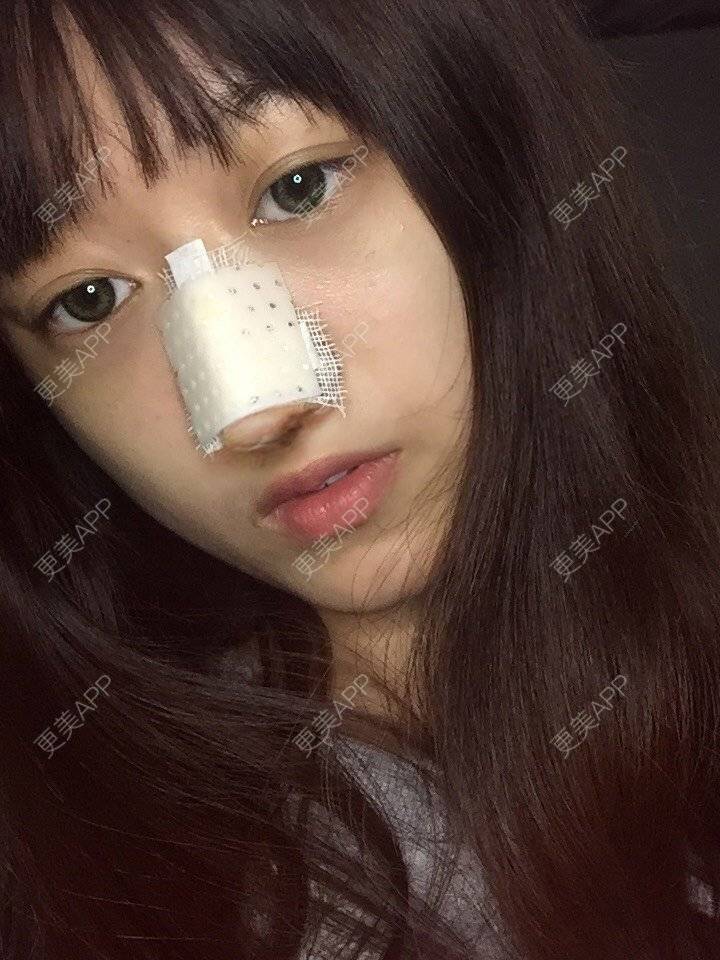 更美 - 妞妞牛小米的鼻部多项经验 | 鼻部多项 | 手术缩鼻头 | 自体软骨垫鼻尖 | 鼻中隔软骨垫鼻头 | 上海