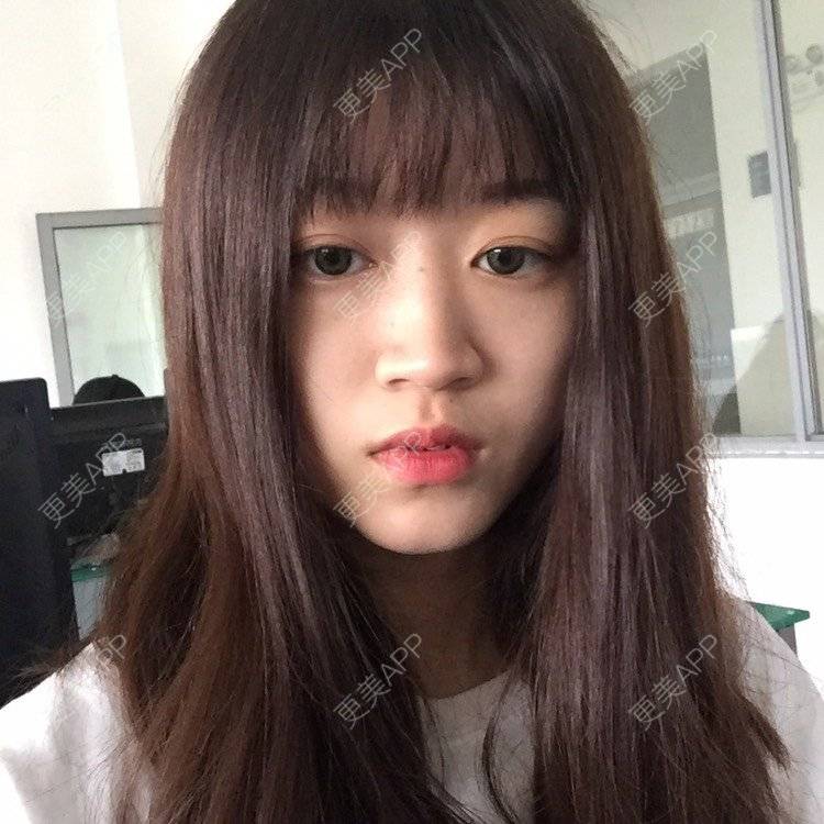 更美 - 妞妞牛小米的鼻部多项经验 | 鼻部多项 | 手术缩鼻头 | 自体软骨垫鼻尖 | 鼻中隔软骨垫鼻头 | 上海