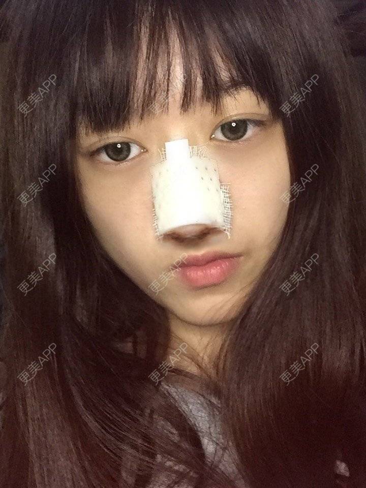 更美 - 妞妞牛小米的鼻部多项经验 | 鼻部多项 | 手术缩鼻头 | 自体软骨垫鼻尖 | 鼻中隔软骨垫鼻头 | 上海