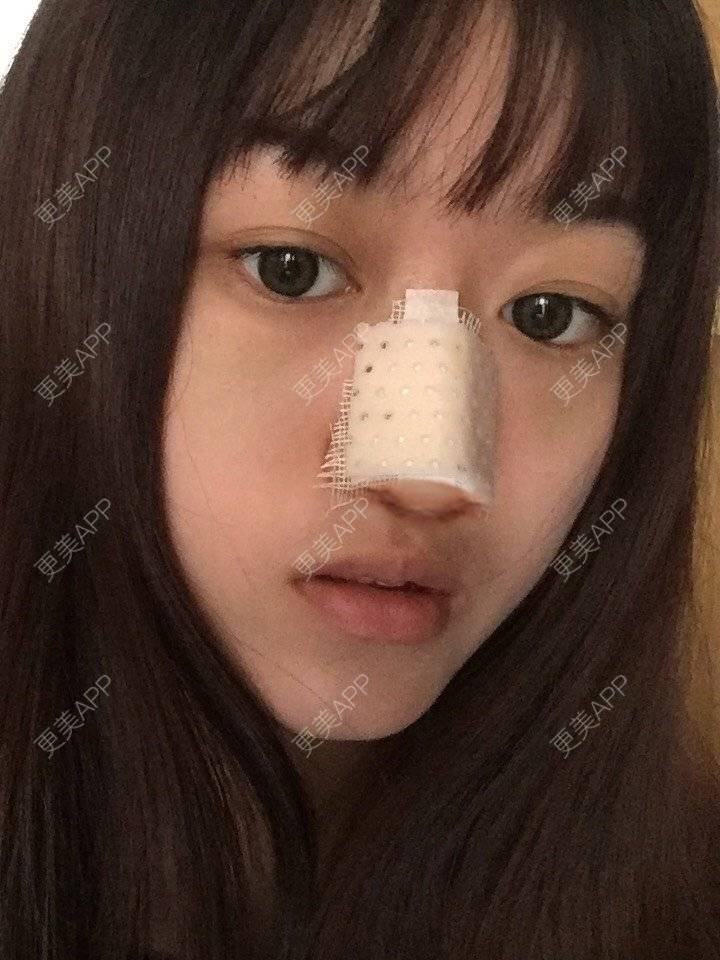 更美 - 妞妞牛小米的鼻部多项经验 | 鼻部多项 | 手术缩鼻头 | 自体软骨垫鼻尖 | 鼻中隔软骨垫鼻头 | 上海