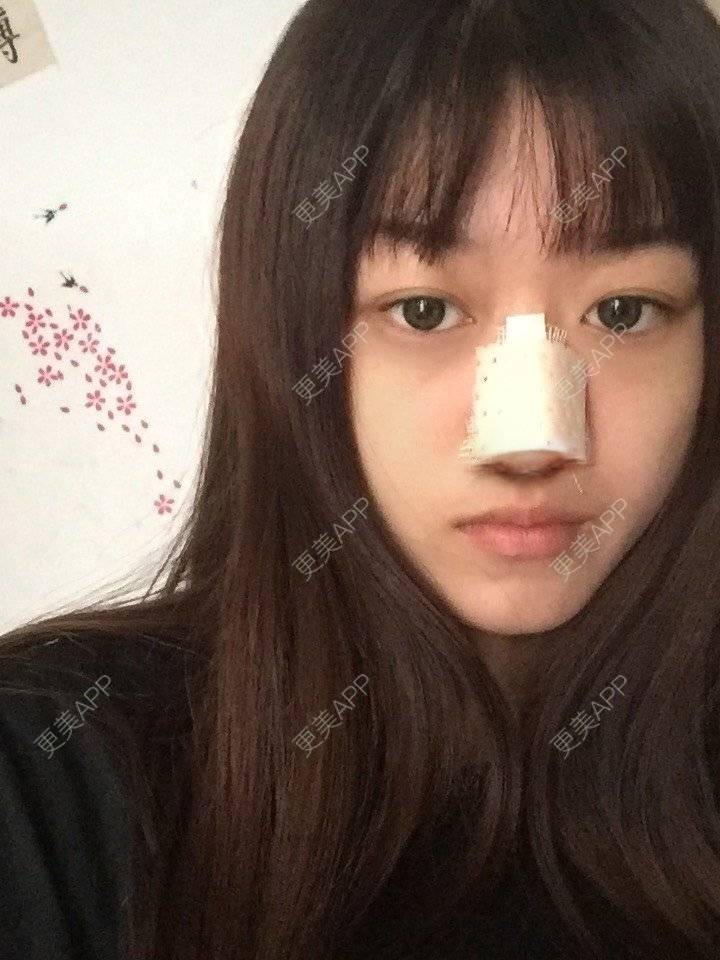 更美 - 妞妞牛小米的鼻部多项经验 | 鼻部多项 | 手术缩鼻头 | 自体软骨垫鼻尖 | 鼻中隔软骨垫鼻头 | 上海