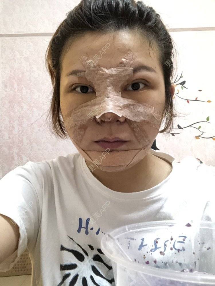 更美 - 更美用户RnU8VdcnCU的鼻部多项经验 | 鼻部多项 | 自体软骨垫鼻尖 | 膨体隆鼻 | 鼻翼缩小 | 佛山 | 鼻小柱延长