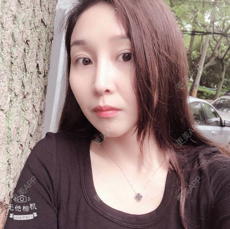 更美 - 蒙蒙噜噜噜的双眼皮修复经验 | 上海 | 双眼皮修复
