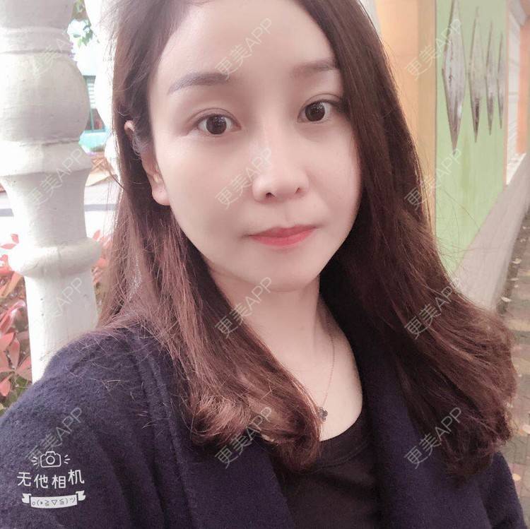 更美 - 蒙蒙噜噜噜的双眼皮修复经验 | 上海 | 双眼皮修复