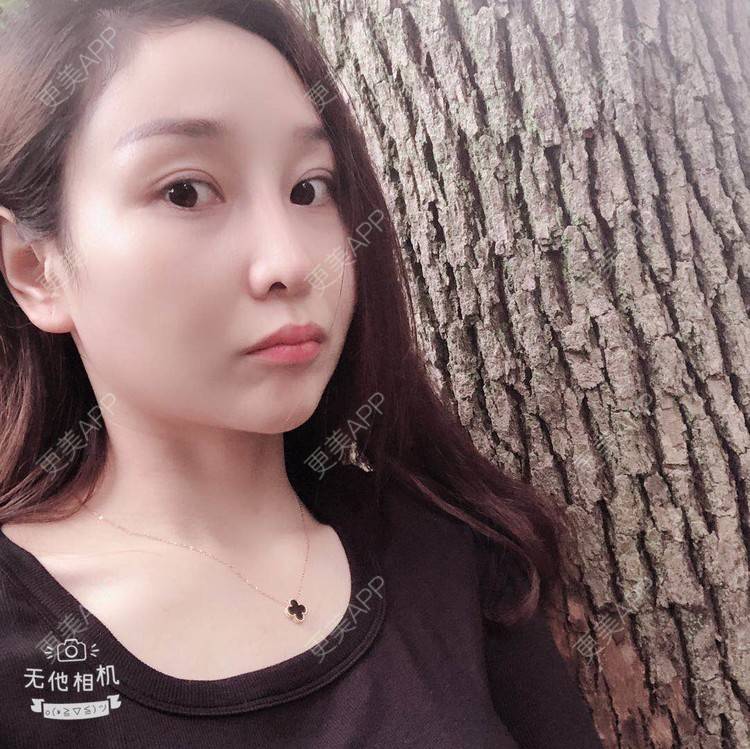 更美 - 蒙蒙噜噜噜的双眼皮修复经验 | 上海 | 双眼皮修复