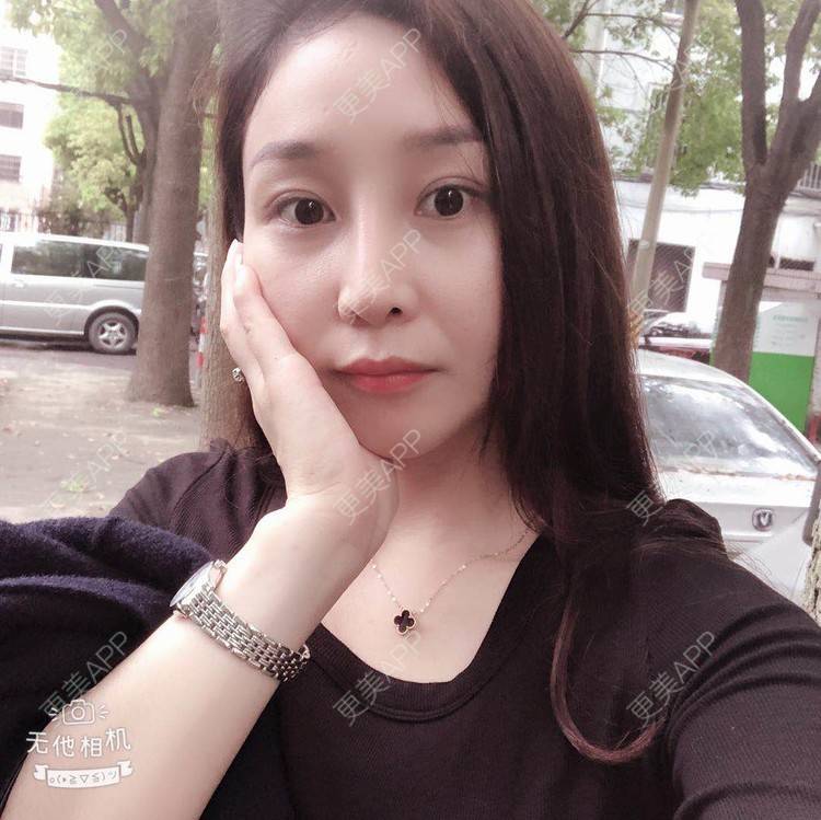更美 - 蒙蒙噜噜噜的双眼皮修复经验 | 上海 | 双眼皮修复