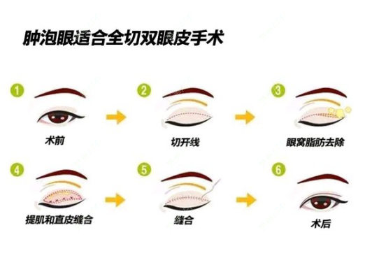 更美 - 康华清医疗美容门诊部的全切双眼皮经验 | 全切双眼皮