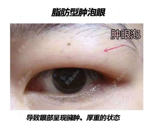 更美 - 康华清医疗美容门诊部的全切双眼皮经验 | 全切双眼皮
