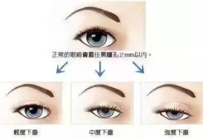 更美 - 康华清医疗美容门诊部的全切双眼皮经验 | 全切双眼皮