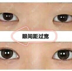 更美 - 康华清医疗美容门诊部的全切双眼皮经验 | 全切双眼皮