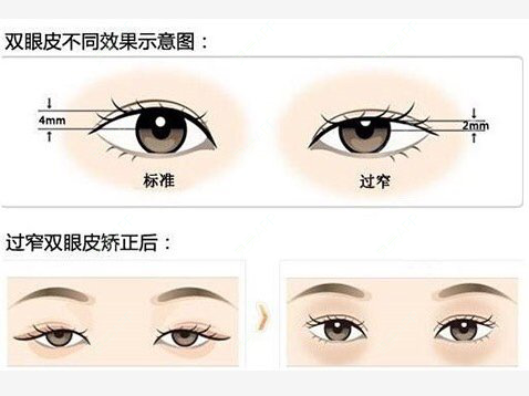 更美 - 康华清医疗美容门诊部的全切双眼皮经验 | 全切双眼皮