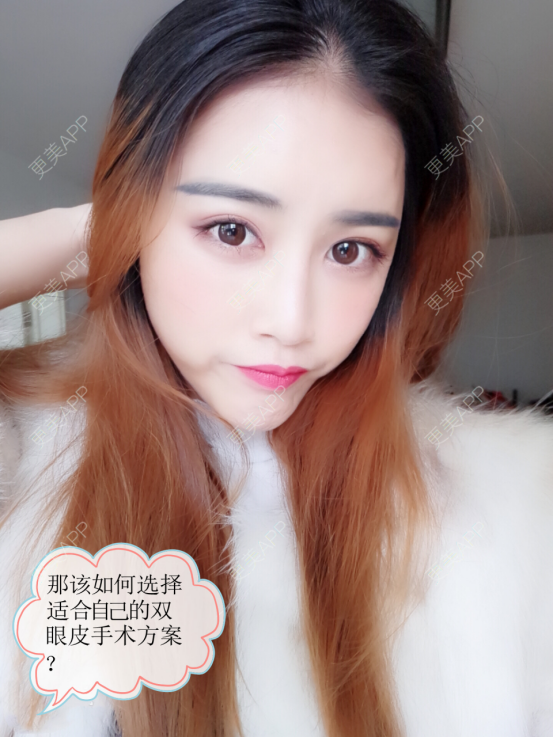 更美 - 康华清医疗美容门诊部的全切双眼皮经验 | 全切双眼皮