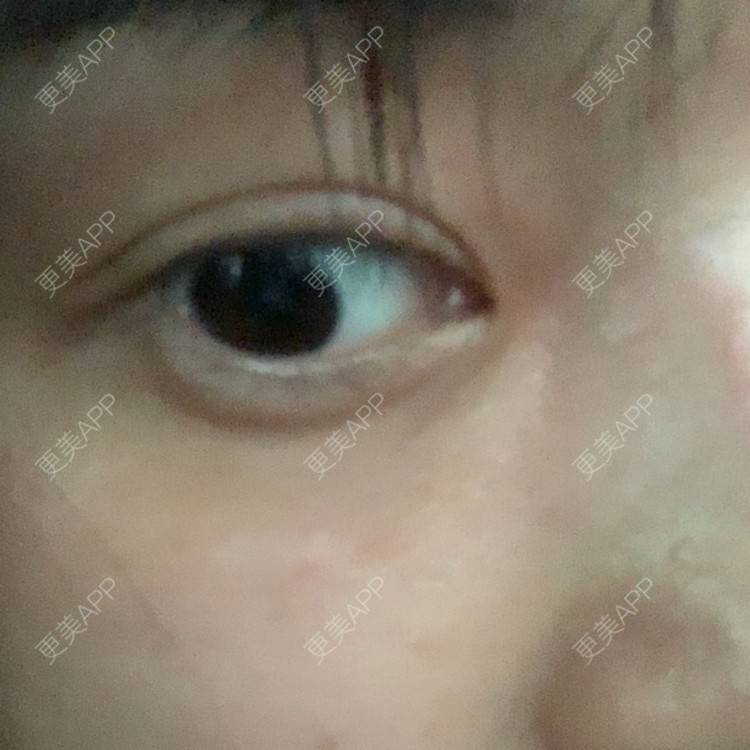 更美 - 香香︶ㄣ的激光淡化黑眼圈经验 | 激光淡化黑眼圈 | 上海