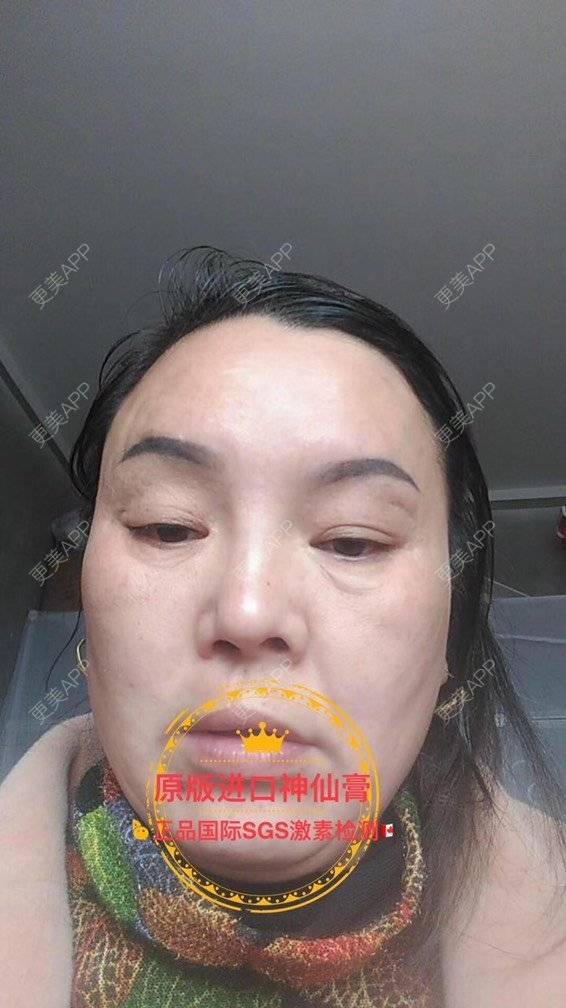 更美 - 卫星co66878的黑脸娃娃经验 | PRP自体血清美肤 | 黑脸娃娃 | 注射美白 | 深圳