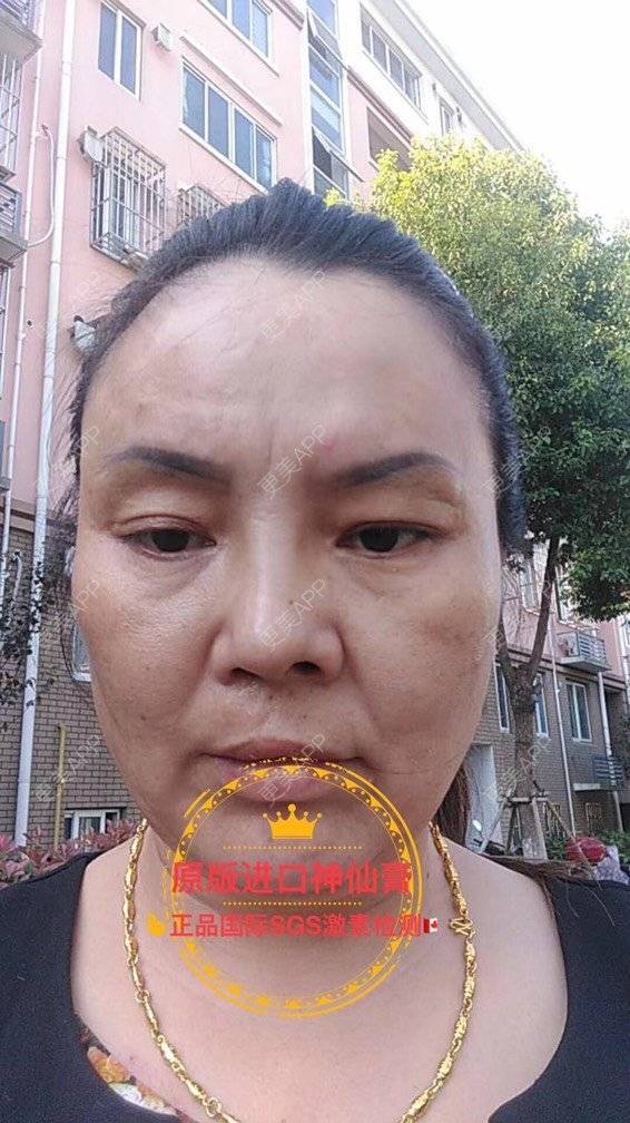 更美 - 卫星co66878的黑脸娃娃经验 | PRP自体血清美肤 | 黑脸娃娃 | 注射美白 | 深圳