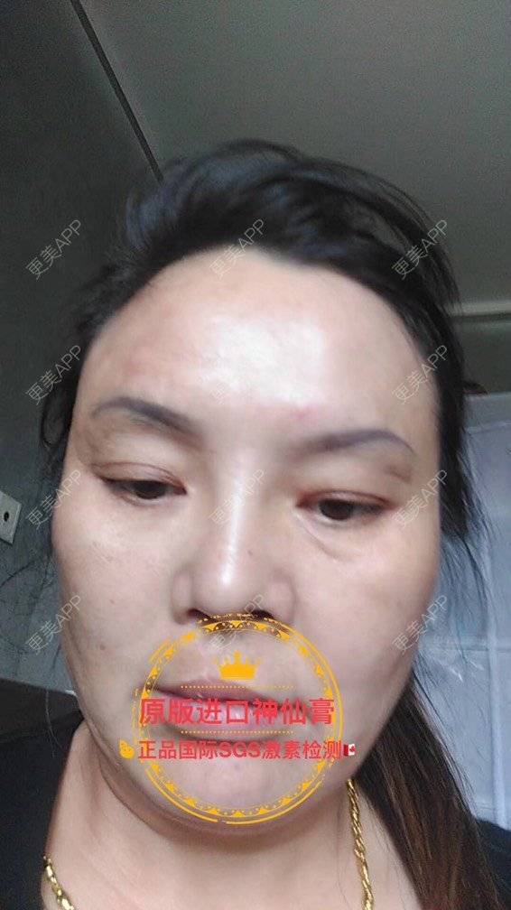 更美 - 卫星co66878的黑脸娃娃经验 | PRP自体血清美肤 | 黑脸娃娃 | 注射美白 | 深圳