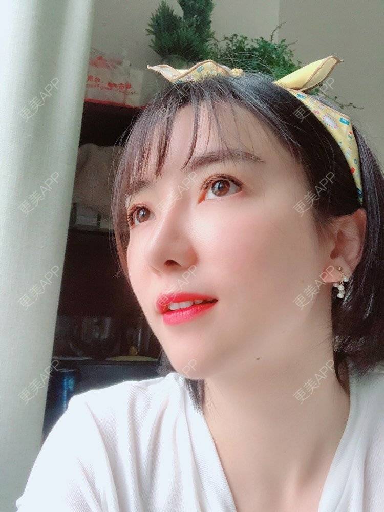 更美 - 向阳葵21的植发际线经验 | 植眉 | 植发际线 | 广州