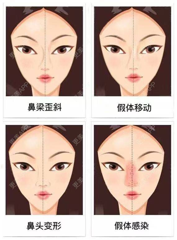 更美 - 康华清医疗美容门诊部的鼻部膨体假体取出经验 | 鼻部膨体假体取出 | 鼻形态修复 | 鼻部硅胶假体取出