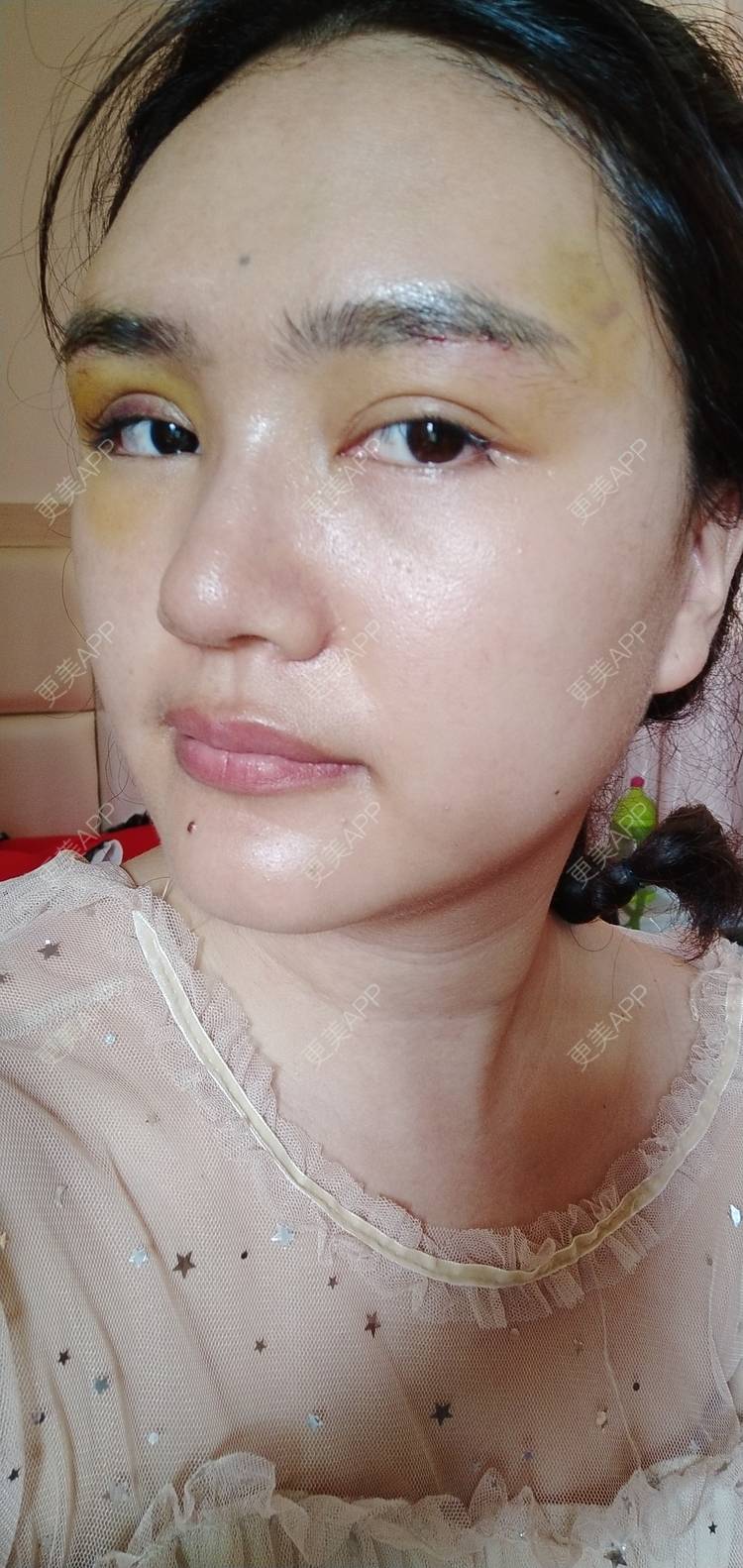 更美 - 红薯冰的硅胶垫眉弓经验 | 北京 | 硅胶垫眉弓