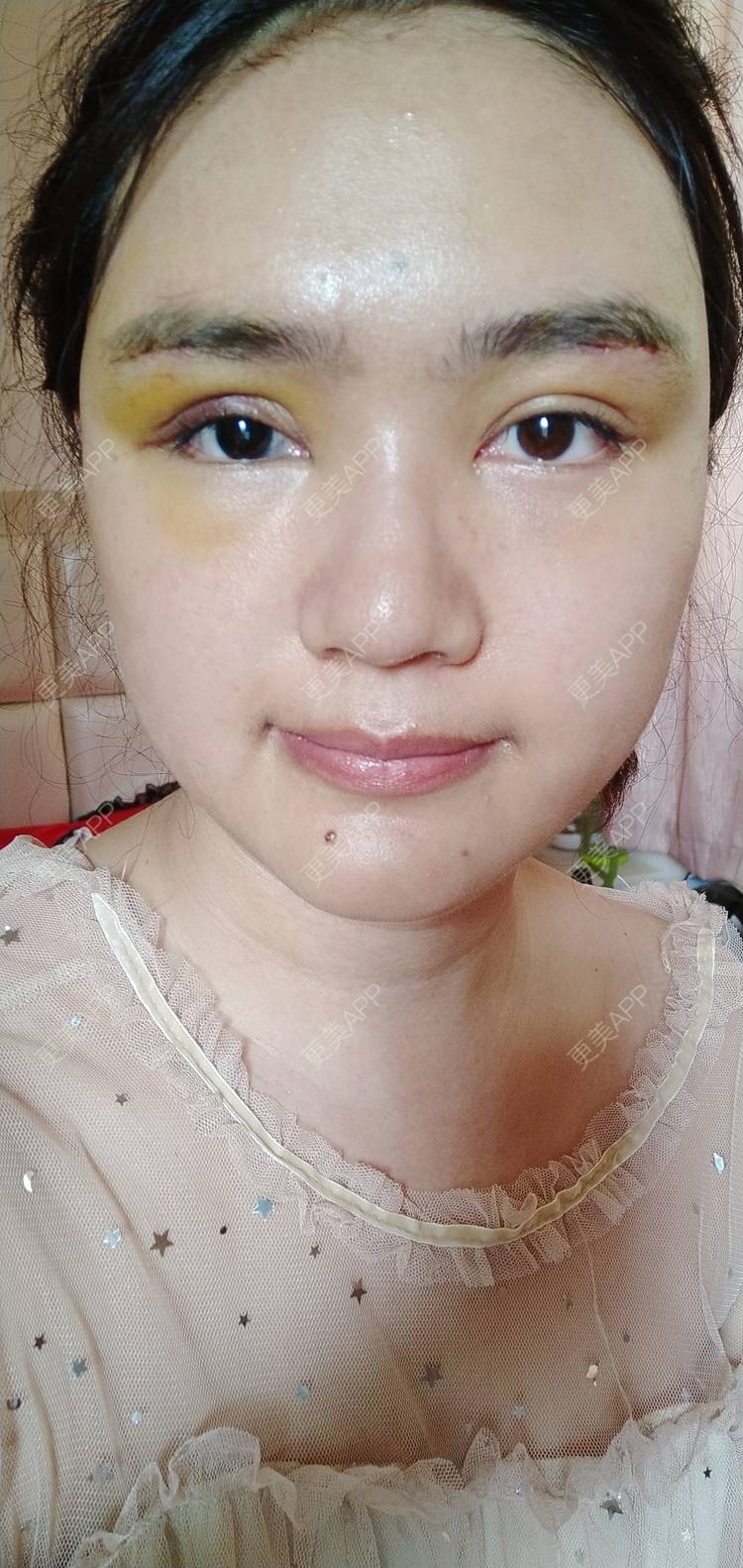 更美 - 红薯冰的硅胶垫眉弓经验 | 北京 | 硅胶垫眉弓